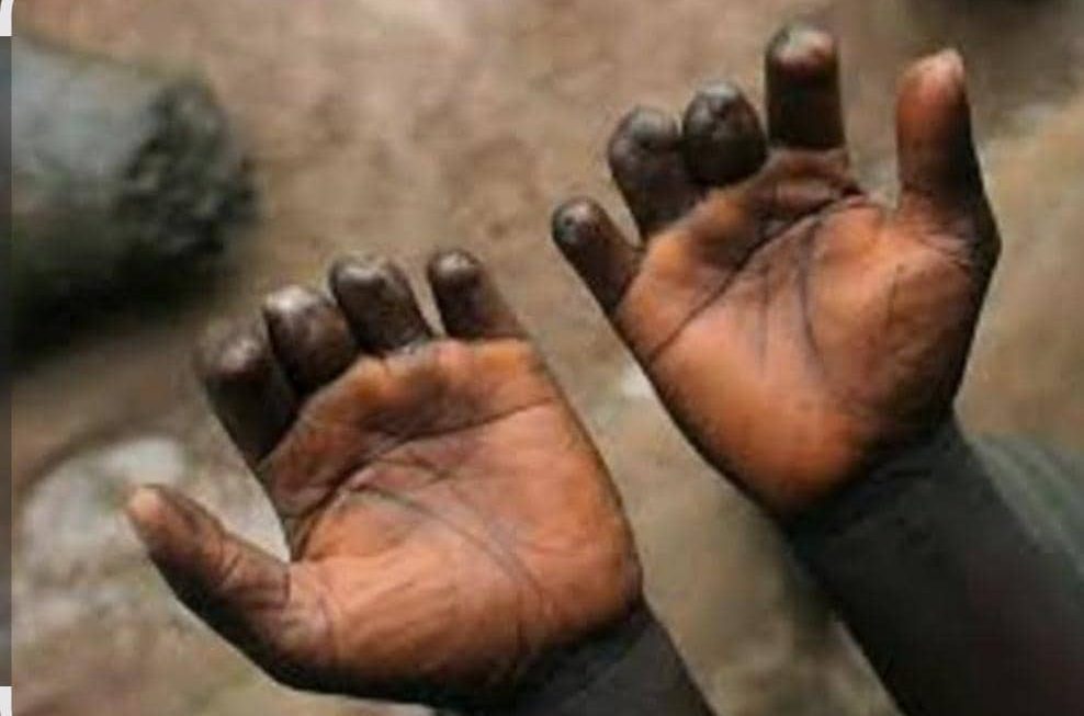 Lèpre à Oicha : des progrès notables face à une maladie toujours présente