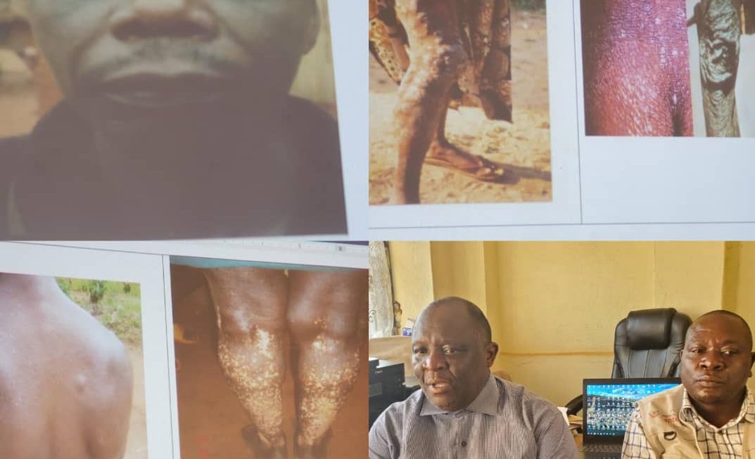 Nord-Kivu : une campagne de distribution gratuite de Mectizan contre l’onchocercose (Kisesi) s&rsquo;annonce à Beni